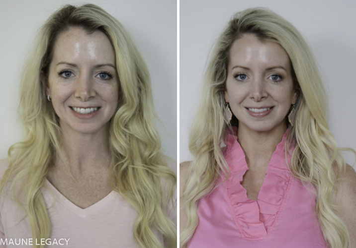 Top Arkansas lifestyle blogger, Jennifer of Maune Legacy, improved her skin with Intense Pulsed Light (IPL) and PhotoFractional therapy with Kimberly Jenkins of Skin Solutions. Click now to see the amazing transformation of her skin!